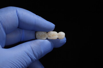 E-max or zirconia glass ceramic porcelain bridge crown treatment and implant-supported crown treatment used in dental dentistry for cases of tooth loss. Smile design. © UniqDream