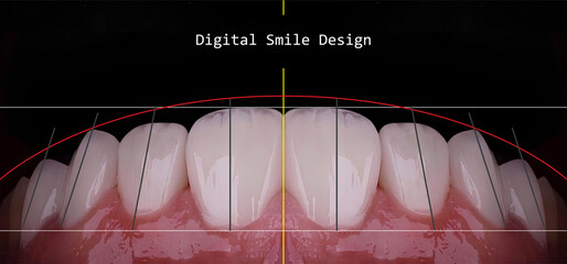 In aesthetic dentistry, smile design treatment involves creating a beautiful smile using computer-aided dental design programs. The design is achieved using E-max and zirconium materials.  © UniqDream