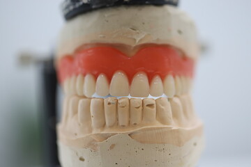 Full arch dental prosthesis treatment applied to edentulous jaws. The complete denture, known as a...
