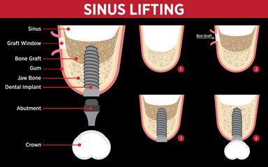 Dental implant treatment in dental dentistry and jaw surgery. Performing implant treatment by lifting the sagging sinus and treating it with bone grafting. Smile makeover. Dental before and after. 