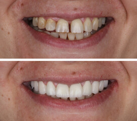 In dental aesthetic dentistry, smile design treatment with laminate veneers and zirconium crowns....