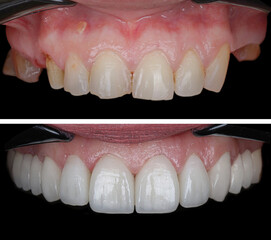 In dental aesthetic dentistry, smile design treatment with laminate veneers and zirconium crowns....