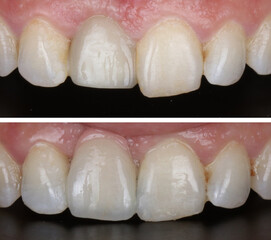 Aesthetic smile design treatment in dental dentistry. Dental treatment with laminate veneers, dental implants, and porcelain crowns. Smile makeover and dental before and after.   © UniqDream