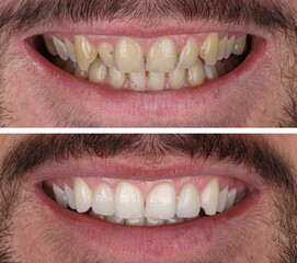 In dental aesthetic dentistry, smile design treatment with laminate veneers and zirconium crowns. Smile makeover dental before and after.