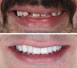In dental aesthetic dentistry, smile design treatment with laminate veneers and zirconium crowns. Smile makeover dental before and after. © UniqDream