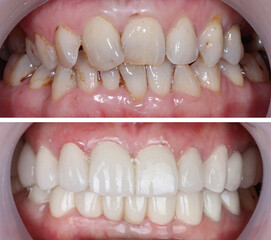 In dental aesthetic dentistry, smile design treatment with laminate veneers and zirconium crowns. Smile makeover dental before and after. © UniqDream