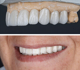 In dental aesthetic dentistry, smile design treatment with laminate veneers and zirconium crowns. Smile makeover dental before and after. © UniqDream