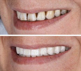 In dental aesthetic dentistry, smile design treatment with laminate veneers and zirconium crowns. Smile makeover dental before and after. © UniqDream