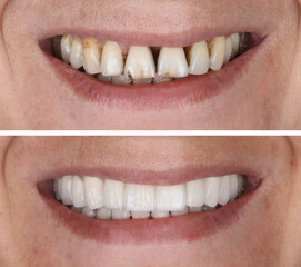 In dental aesthetic dentistry, smile design treatment with laminate veneers and zirconium crowns. Smile makeover dental before and after.