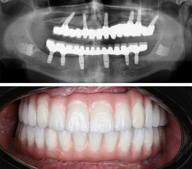 In dentistry, dental implant treatment involves placing a full arch dental prosthesis on 4...