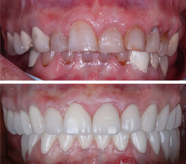 In dental aesthetic dentistry, smile design treatment with laminate veneers and zirconium crowns. Smile makeover dental before and after. © UniqDream