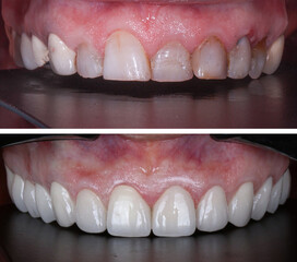 In dental aesthetic dentistry, smile design treatment with laminate veneers and zirconium crowns. Smile makeover dental before and after. © UniqDream