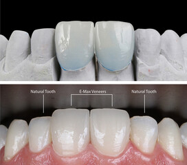 Aesthetic smile design treatment in dental dentistry. Dental treatment with laminate veneers, dental implants, and porcelain crowns. Smile makeover and dental before and after.   © UniqDream