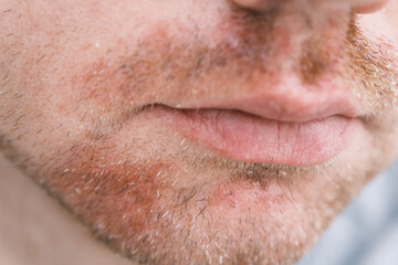 A close-up of a man's face with visible stubble and redness caused by seborrheic dermatitis,...