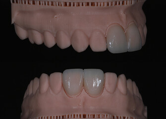 Computer-aided smile design treatment with porcelain crowns in digital dental dentistry. Digital jaw model with laminate veneers for dental smile design. Smile makeover.  © UniqDream