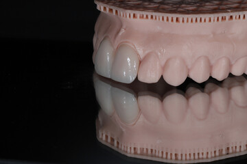 Computer-aided smile design treatment with porcelain crowns in digital dental dentistry. Digital jaw model with laminate veneers for dental smile design. Smile makeover.  © UniqDream