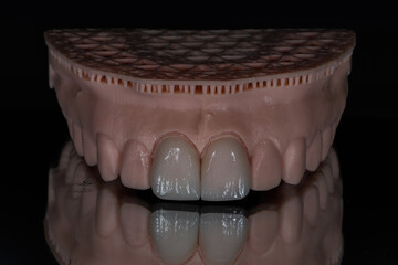 Computer-aided smile design treatment with porcelain crowns in digital dental dentistry. Digital jaw model with laminate veneers for dental smile design. Smile makeover.  © UniqDream