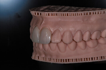 Computer-aided smile design treatment with porcelain crowns in digital dental dentistry. Digital jaw model with laminate veneers for dental smile design. Smile makeover.  © UniqDream