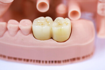 Porcelain bridge crown treatment designed with digital dentistry and produced on a jaw model using a 3D printer. dental smile makeover. laminate veneers  © UniqDream