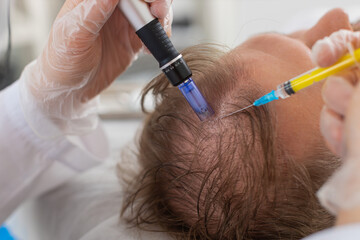 Alopecia. Man hair loss improve growth treatment regeneration, dermapen microneedling, vitamin...