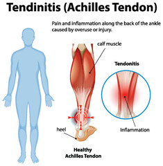 Achilles Tendonitis Medical Illustration