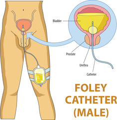 illustration of foley catheter in male diagram