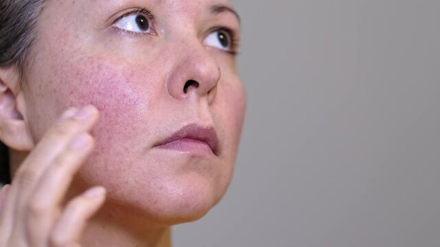 Close-up of a young woman with facial redness and couperose. Highlights skin sensitivity and inflammation, emphasizing skincare needs and dermatology treatments.