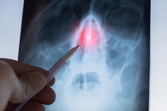 Doctor learning X-ray scan of a human skull. Deviated septum. Nasal septum, bone and cartilage that divide the nose in the middle is crooked. Breathing through the nose difficult, smell affected.