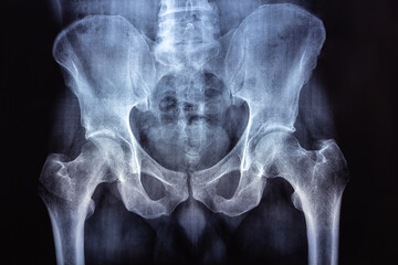 MRI of Bones of the Lumbar Spine and Pelvis. Pinched discs of spine and nerves. Intervertebral disc herniation.