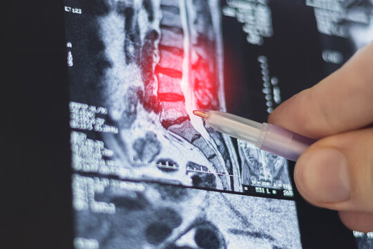 Doctor learn Magnetic resonance image of human spine. MRI of lumbar spine. Pinched discs of spine and nerves. Intervertebral disc herniation.