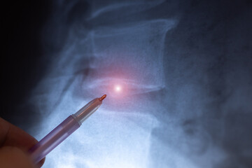 Doctor learn X-ray scan of intervertebral discs in spine. Close up.