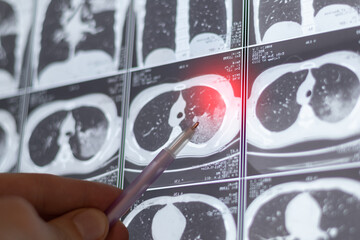 Diagnostic of X-ray or MRI scan of human lungs. Close up.