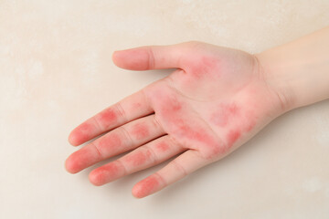 hand with red spots on it. The spots are small and scattered. The hand is on a table