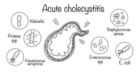 Acute cholecystitis