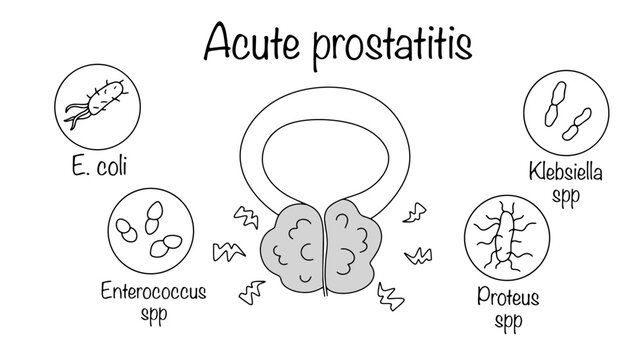 Acute prostatitis