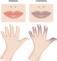 Medical illustration of symptoms of cyanosis