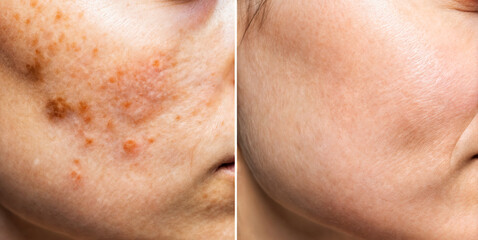 Fototapeta premium Before and After Skincare Treatment Highlighting Acne and Smooth Complexion Transformation