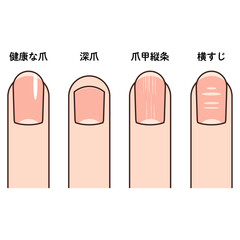 指先のイラスト（健康な爪、深爪、爪甲縦条、波板状爪）