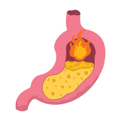 concept illustration of stomach ulcers, GERD, vector illustration.