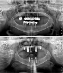 Full-arch dental prosthesis with the All on Four and All on X treatment concept for edentulous jaws in dental implant treatment. Dental X ray image and dental before and after smile design. © UniqDream