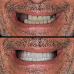 Full-arch dental prosthesis with the All on Four and All on X treatment concept for edentulous jaws...