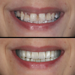 In aesthetic dentistry, E-Max and zirconium porcelain crowns are used to align teeth and treat discolored teeth. Dental before and after smile makeover. Tooth and teeth treatment smile design
