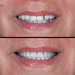 In aesthetic dentistry, E-Max and zirconium porcelain crowns are used to align teeth and treat discolored teeth. Dental before and after smile makeover. Tooth and teeth treatment smile design  © UniqDream