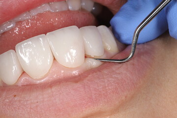 Restoring aesthetics and chewing function with glass-ceramic porcelain dental crowns in dental aesthetic dentistry.   © UniqDream