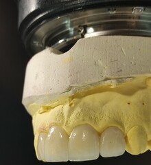 Supporting and strengthening tooth enamel with porcelain crowns in dental aesthetic dentistry.   © UniqDream