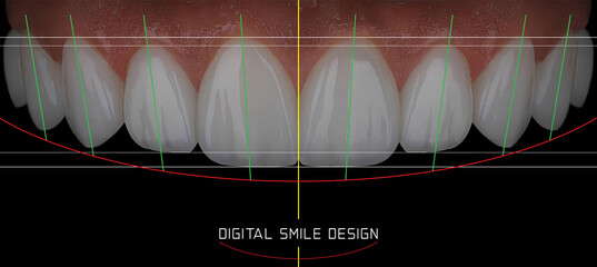 Smile design treatment applied to a woman with beautiful lips in aesthetic dentistry. Digital smile design and smile makeover with E-max and zirconium porcelains for tooth arrangement.