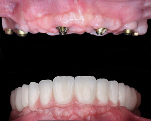 In dental dentistry, jaw surgery with dental implant treatment for edentulous jaw full-arch dental prosthesis. Dental before and after smile makeover. Implant-supported tooth crown.
