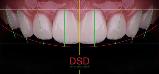 In digital dentistry, dental smile design treatment involves applying computer-designed teeth into the mouth. The process includes dental before-and-after images.  © UniqDream