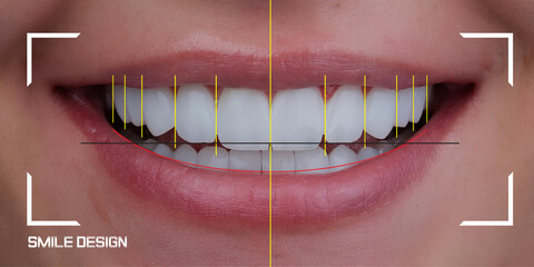 Computer-aided design for tooth alignment and smile design treatment in cosmetic dentistry. Smile makeover, dental before and after. Digital smile design. laminate veneers crown
