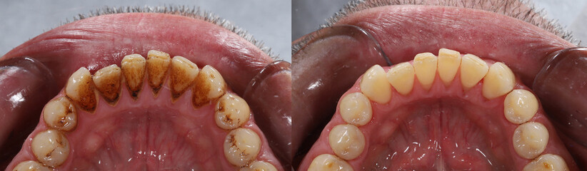 Before and after cleaning of stains and tartar on the tooth surface by a dentist in dental dentistry.

